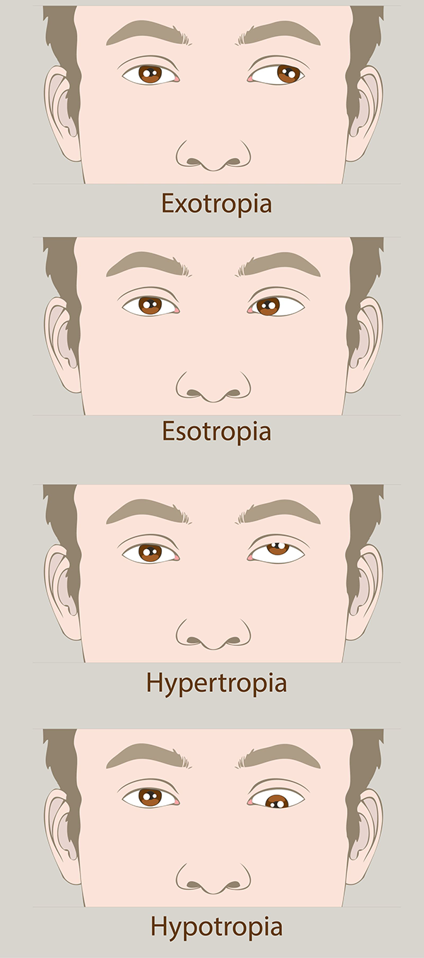 amblyopia west new york