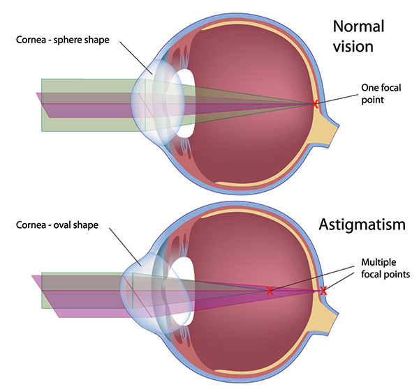 astigmatism west new york