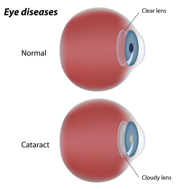 cataracts exam west new york