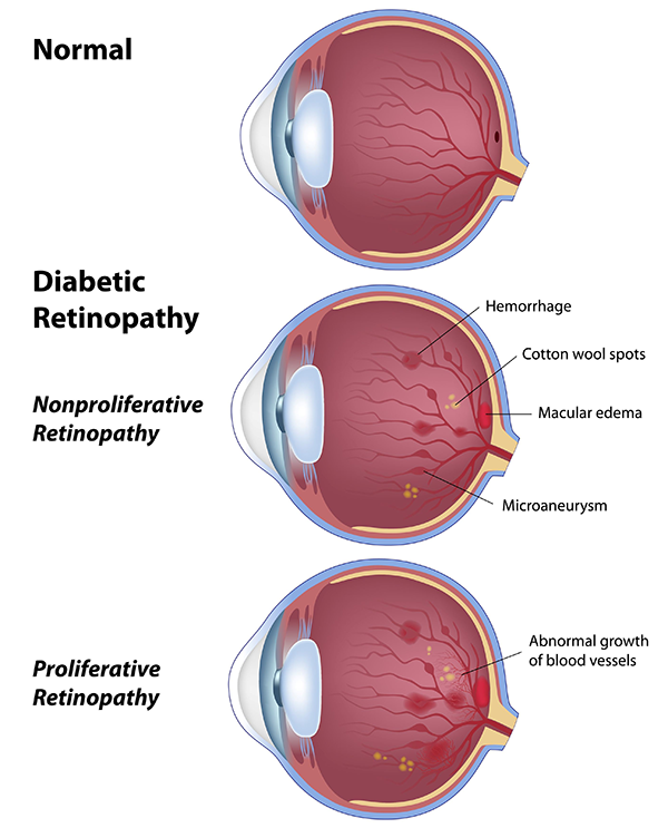 diabetic retinopathy west new york