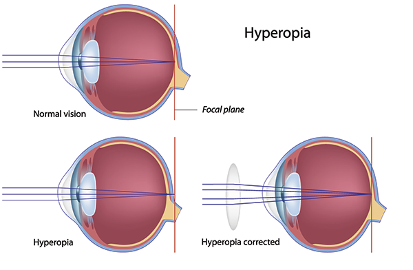 farsightedness in west new york