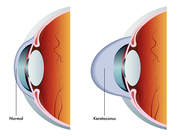 keratoconus west new york