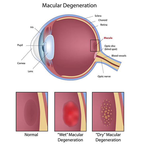 west new york macular degeneration