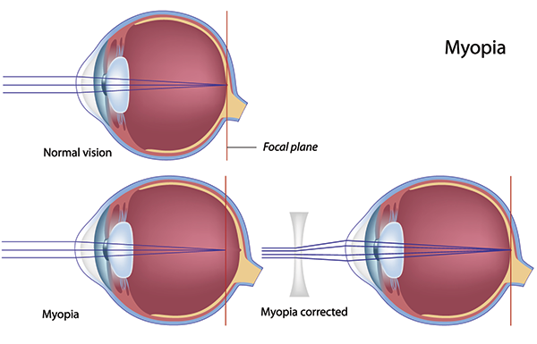 west new york nearsightedness