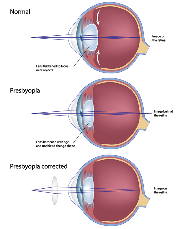 presbyopia west new york