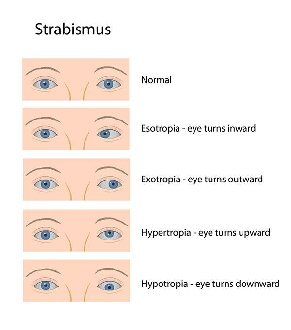 strabismus west new york